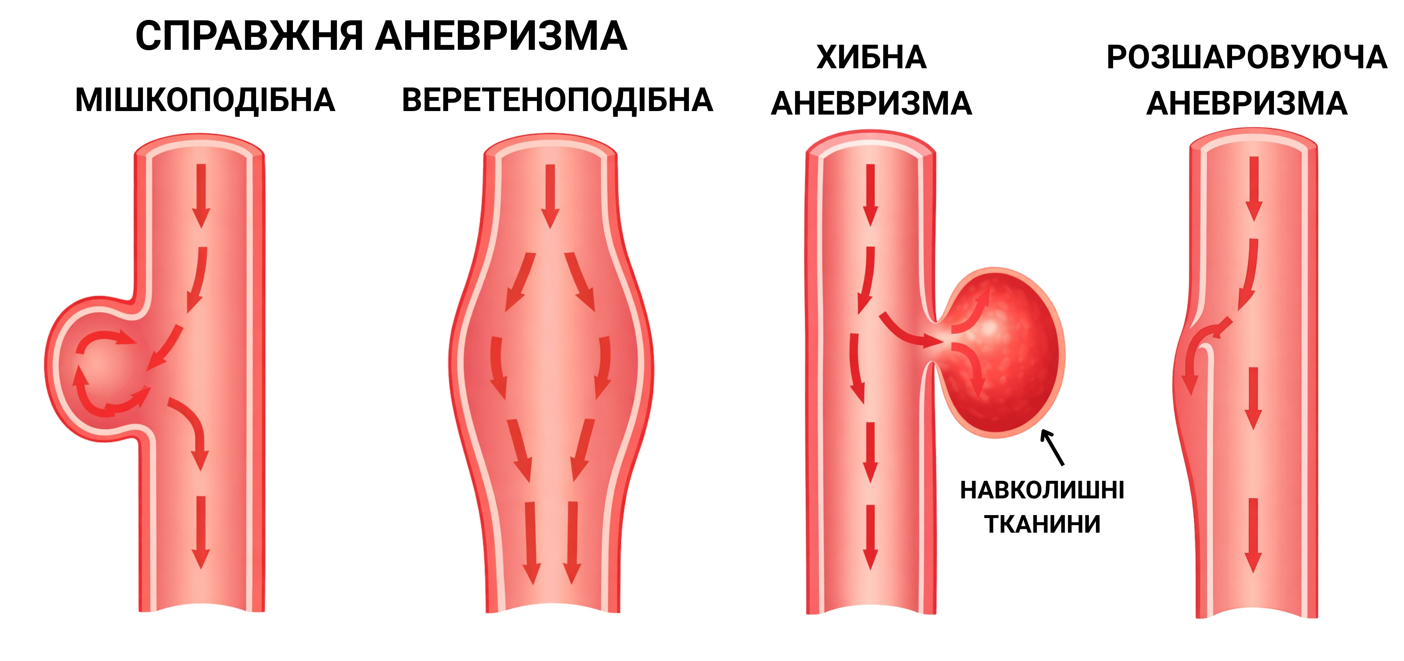 аневризми