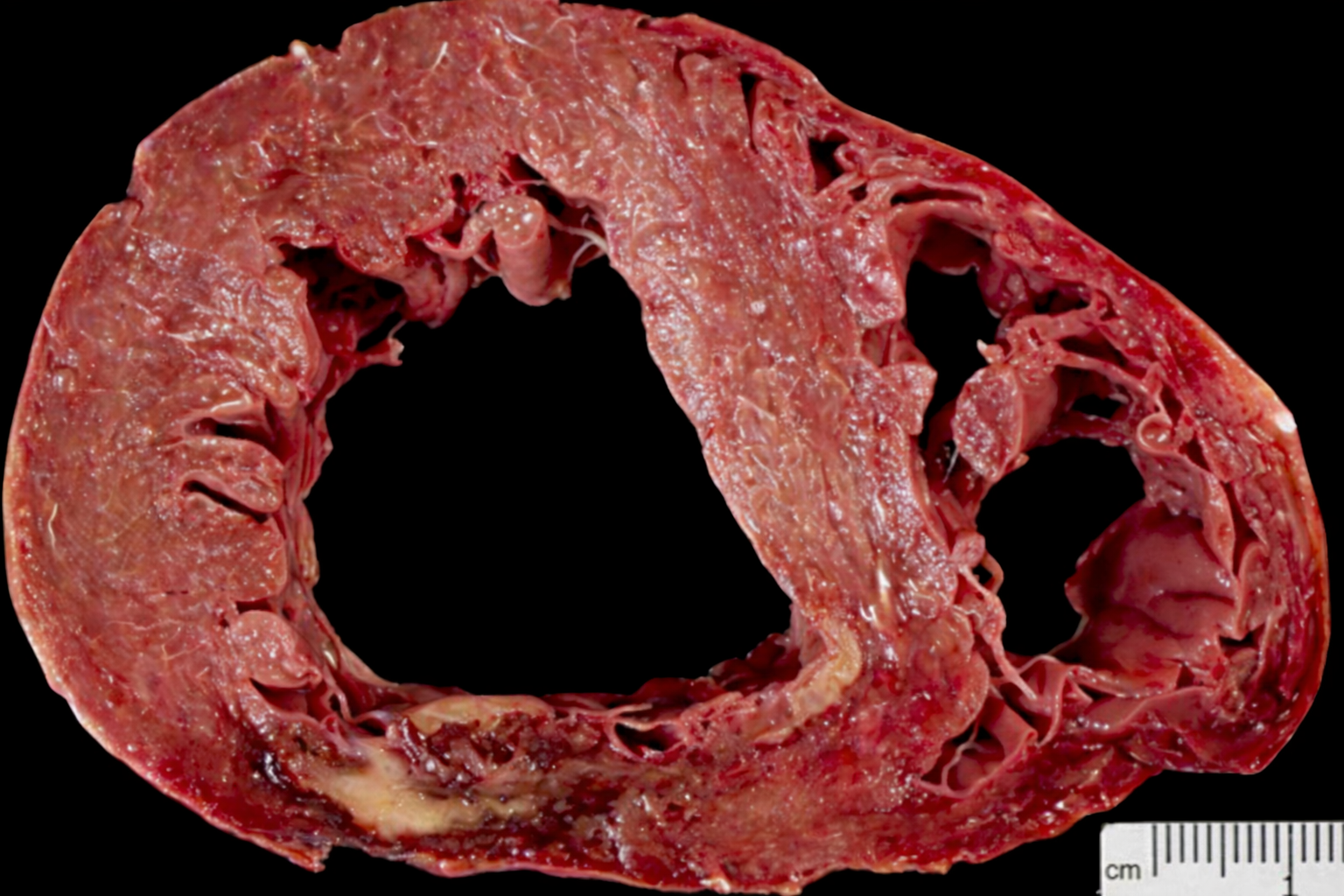 Інфаркт 3-7 днів макро