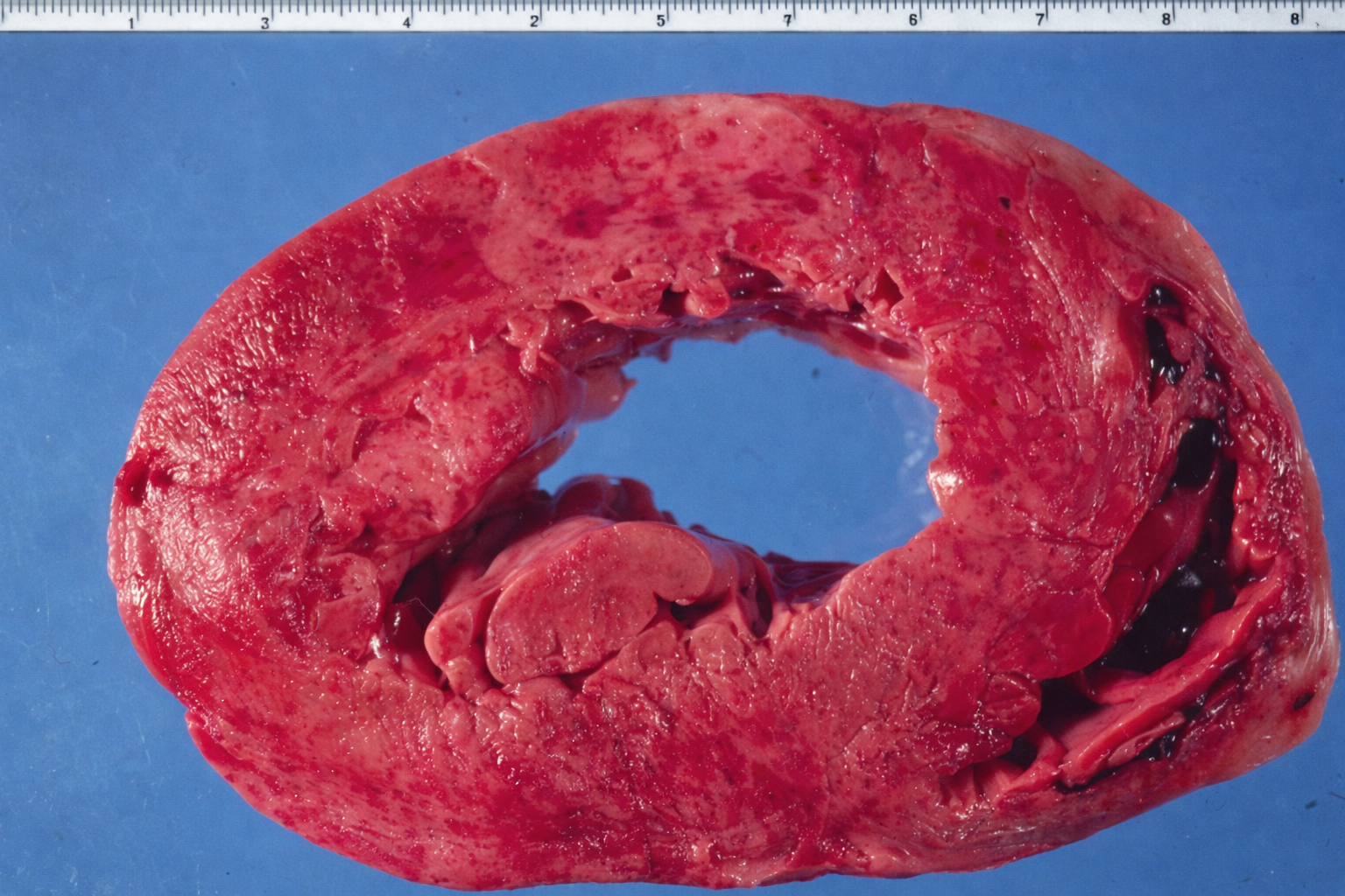 mottling myocardial infarction